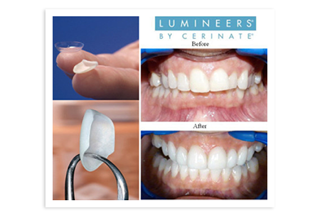Cosmetic Dentistry - Lumineers