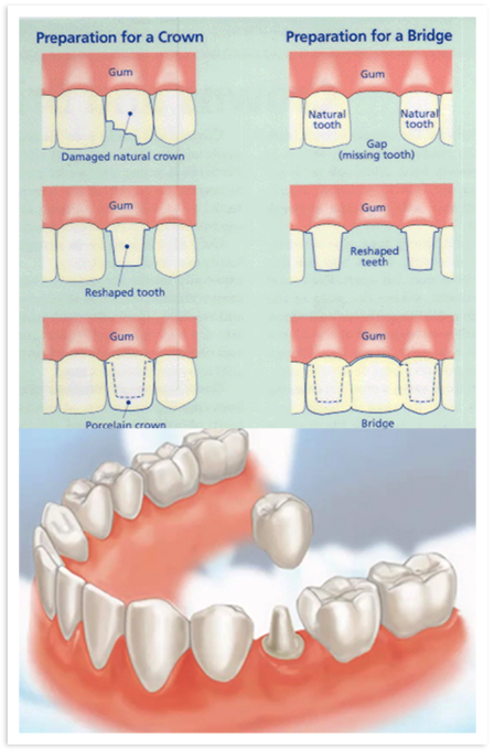 Dental Crowns & Bridges