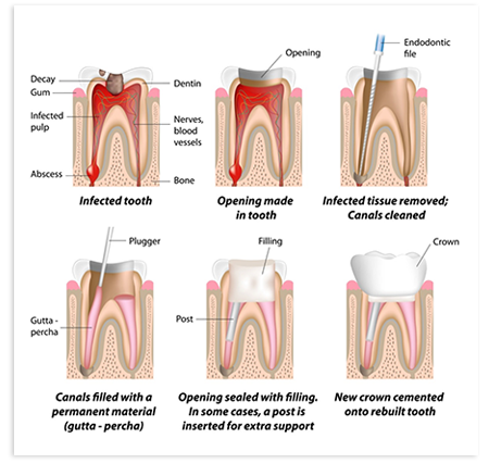 Root Canal Treatment